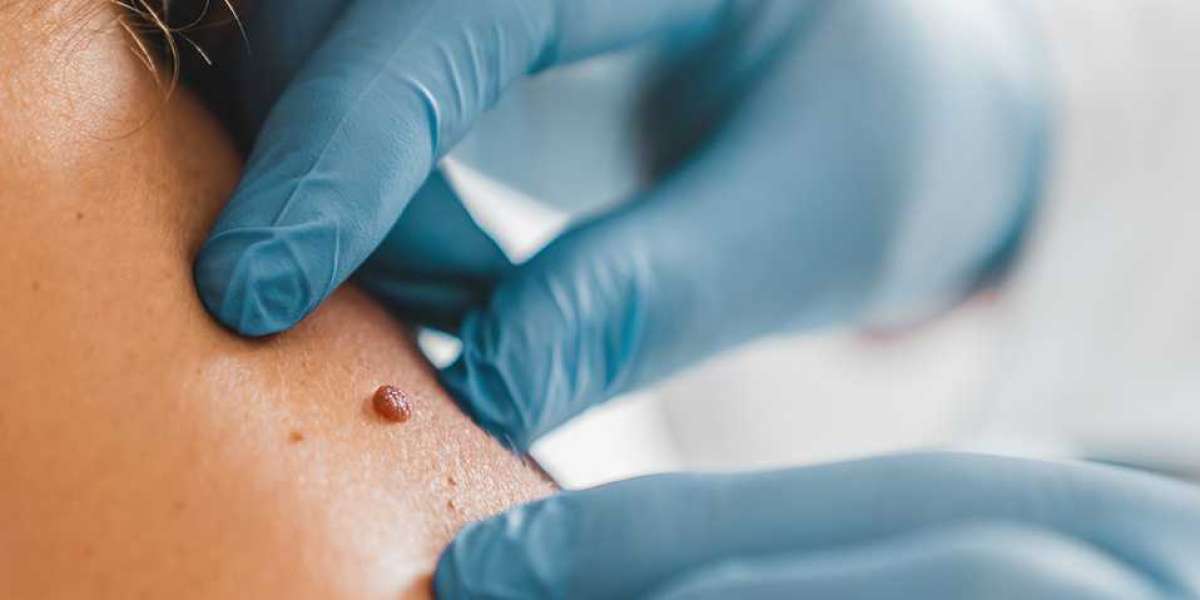 An Effective Skin Tags Removal Treatment: DNA Skin Clinic