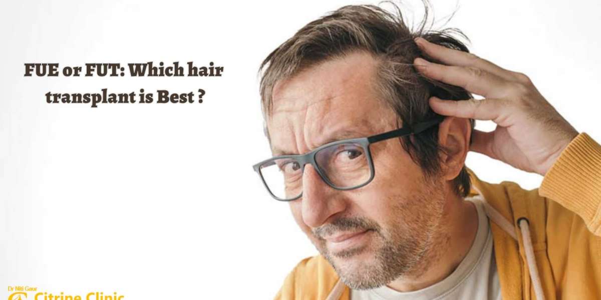 FUE or FUT: Which hair transplant is Best?