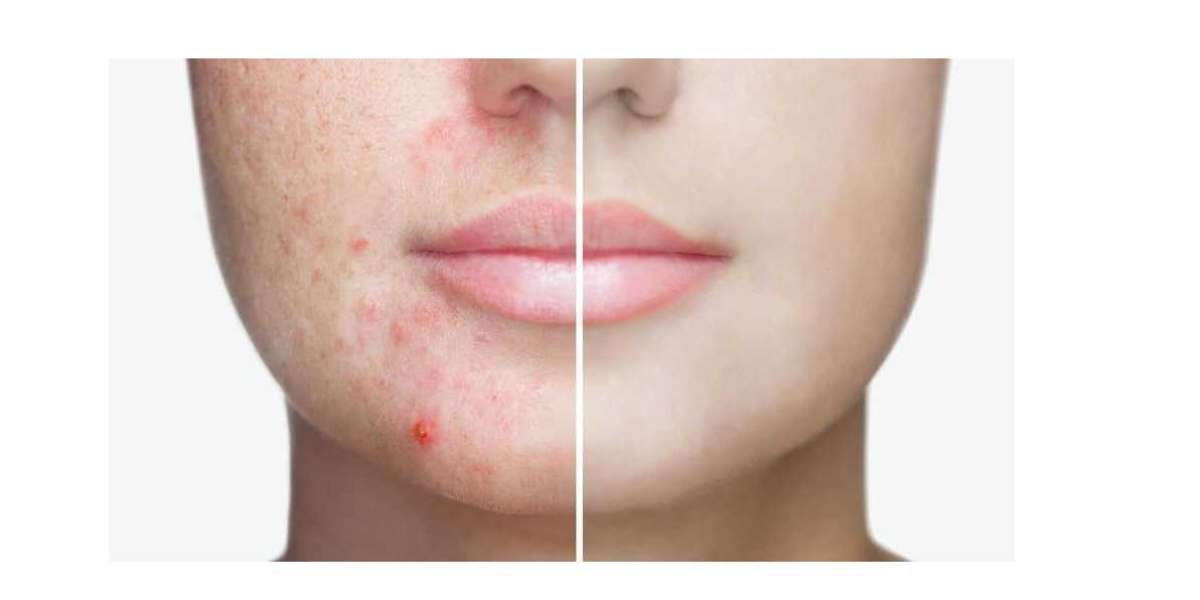What To Expect From An Acne Treatment Clinic